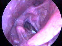 T1 Verrucous Carcinoma of the Larynx - True Vocal Cord