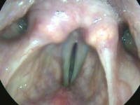 Bowed Vocal Cords in a Pateint with Presbylarynges