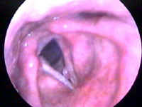 Large Left True Vocal Cord Nodule