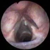 True Vocal Cord Cyst of the Larynx
