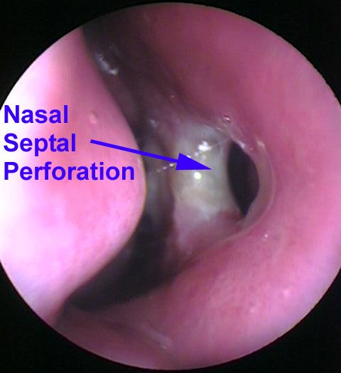 Nasal Septal Perforation