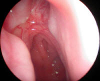Large posterior nasal vessel which can cause nose bleeding