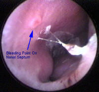 Nose bleed caused by a ruptured vesses on the anterior nasal septum