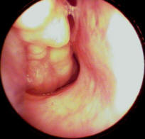 Picture of Nasal Papilloma