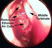 Ethmoidectomy - Fess - Functional Endoscopic Sinus Surgerya