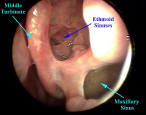 Maxillary and Ethmiod Sinuses after Functional Endoscopic Sinus Surgery