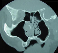 Coronial CT Scan of Inverted Papilloma of the Nasal Cavity