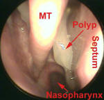 Functional Endoscopic Sinus Surgery for Nasal Polyps - Nasal Polyposis