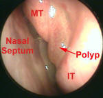 FESS for Nasal Polyps - Nasal Polyposis