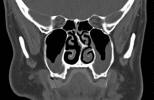 CT Scan of Septal Spur