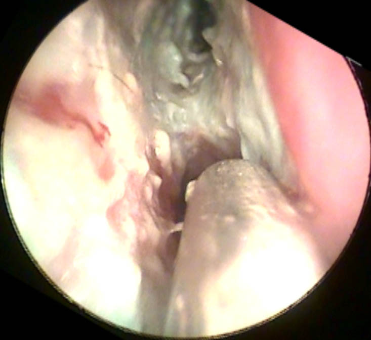 Dead Nasal Mucosa Above the Left Inferior Turbinate