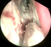 Dead Mucosa Below the Inferior Turbinate, Adhesion of the Interior Turbinate to the Nasal Septum