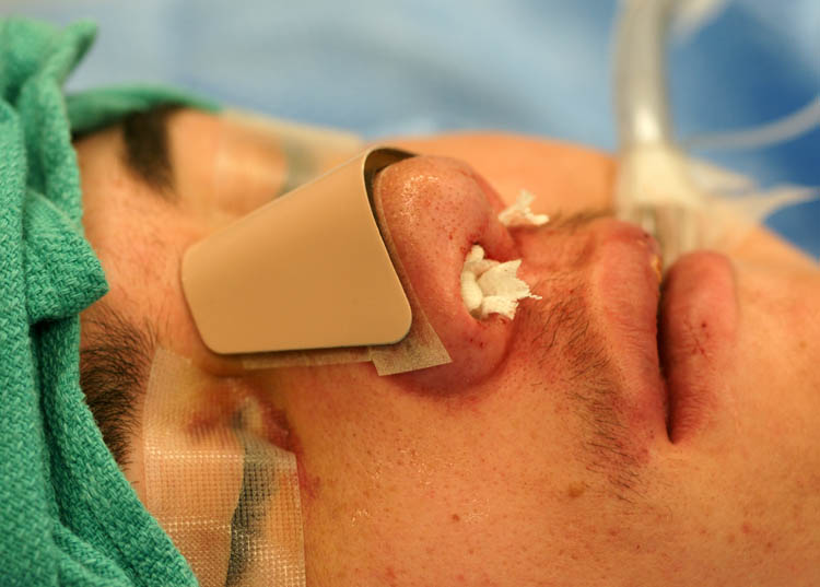 Nasal Cast and Stabilization of a Broken Nose