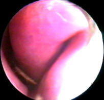 Picture of a Foreign Body in the Nose