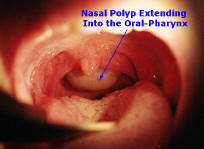 Nasal Polyp in Oral-Pharynx