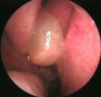 Picture of Nasal Polyps