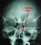 Nasal Septal Spur - X-Ray