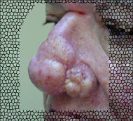 rhinophyma - Second Stage Appearance Left Side