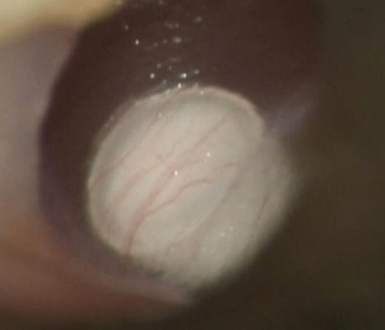 Inferior Cholesteoma Behind Left Tympanic Membrane (Eardrum)
