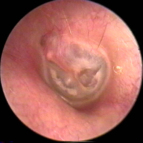 Picture of an Eardrum with Tympanosclerosis.  The patient had a patulous eustachian tube.