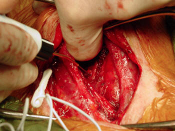 Thyroidectomy - Stimulation of Recurrent Laryngeal Nerve