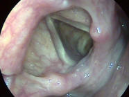 Normal Larynx or Voice Box
