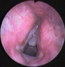 Larynx Mass - Large Vocal Cord Nodule