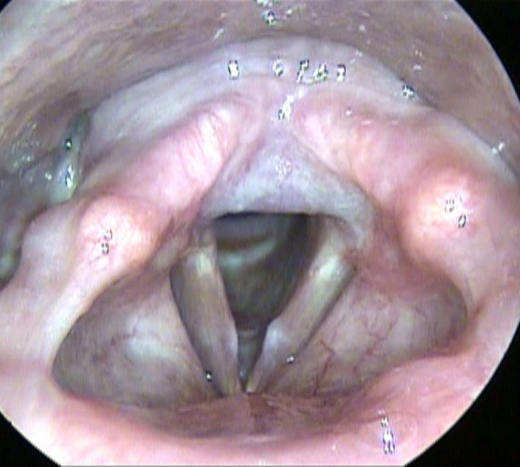 Bilateral Vocal Cord Polyps with Keratosis