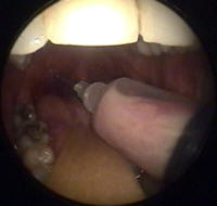 Needle Drainage of Pertonsillar Abscess (Quinsy)