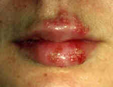 Cold Sores Caused by Herpes Simplex Virus