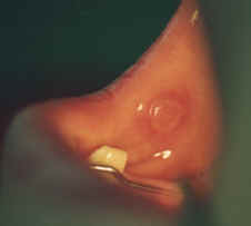 Apthosis Ulcer of Buccal Mucosa