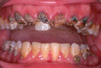 Meth Mouth from methamphetamine abuse