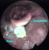 Lingual Hemangioma on Tongue Base