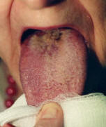 black hairy tongue after treatment