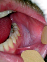 leukoplakia of the oral mucosa
