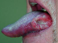 squamous cell carcinoma of the tongue