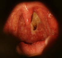 Necrosis of Posterior Oral Pharynx form Intranasal Narcotic Usage