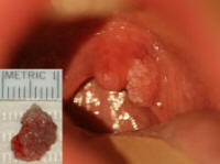 Large Oral Papilloma from HPV