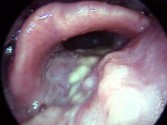 squamous cell carcinoma of the hypopharynx with airway obstruction