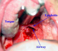 squamous cell carcinoma of the hypopharynx