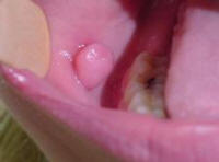 Oral Fibroma on Buccal Mucosa