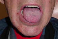 Shingles Caused by Herpes Zoster Virus