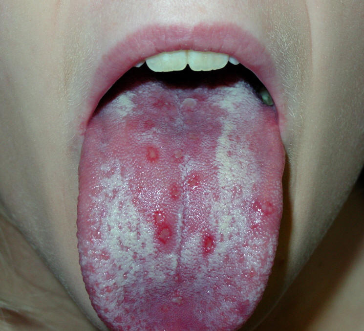 Stomatitis caused by Herpes Virus With Blisters on the Tongue