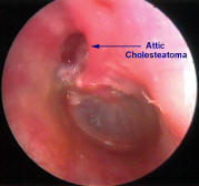 Attic Cholesteatoma