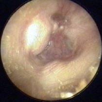 Prolapse of Anterior Ear Canal
