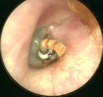 Plugged Ear (Myringotomy) Tube