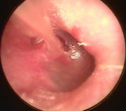 Middle Ear Fluid Found During Ear Tube Insertion