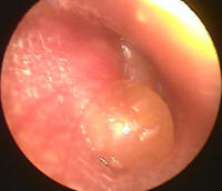 Acute Otitis Media With Blistering of the Eardrum