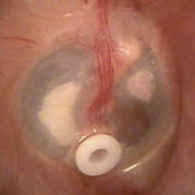Ear (Myringtomy) Tube and Tympanosclerosis