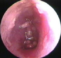 Maggots in the Ear Canal